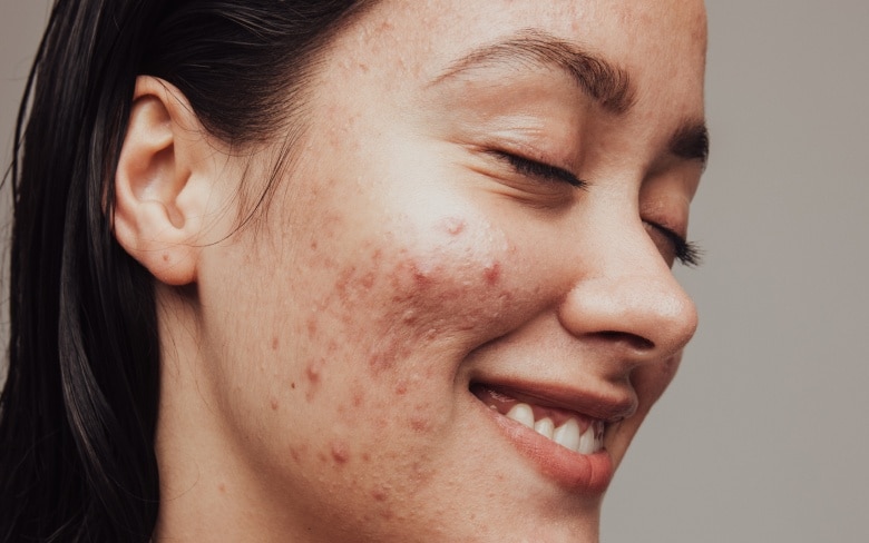 Visage d une jeune femme avec des boutons sur ses joues - hydrafacial et acne quelle efficacite | Dr Santini Paris 16