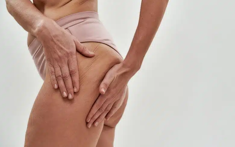 Femme d age moyen montrant la cellulite sur ses fesses - a quoi est due la cellulite | Dr Santini Paris 16