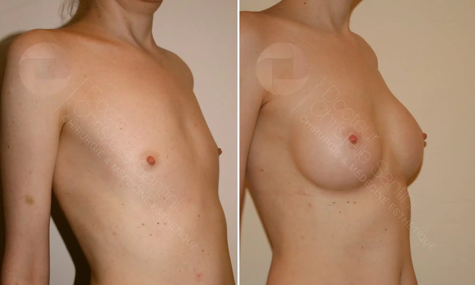Photo de profile droit des seins d une jeune femme avant/apres une augementation mammaire | Dr Santini Paris 16