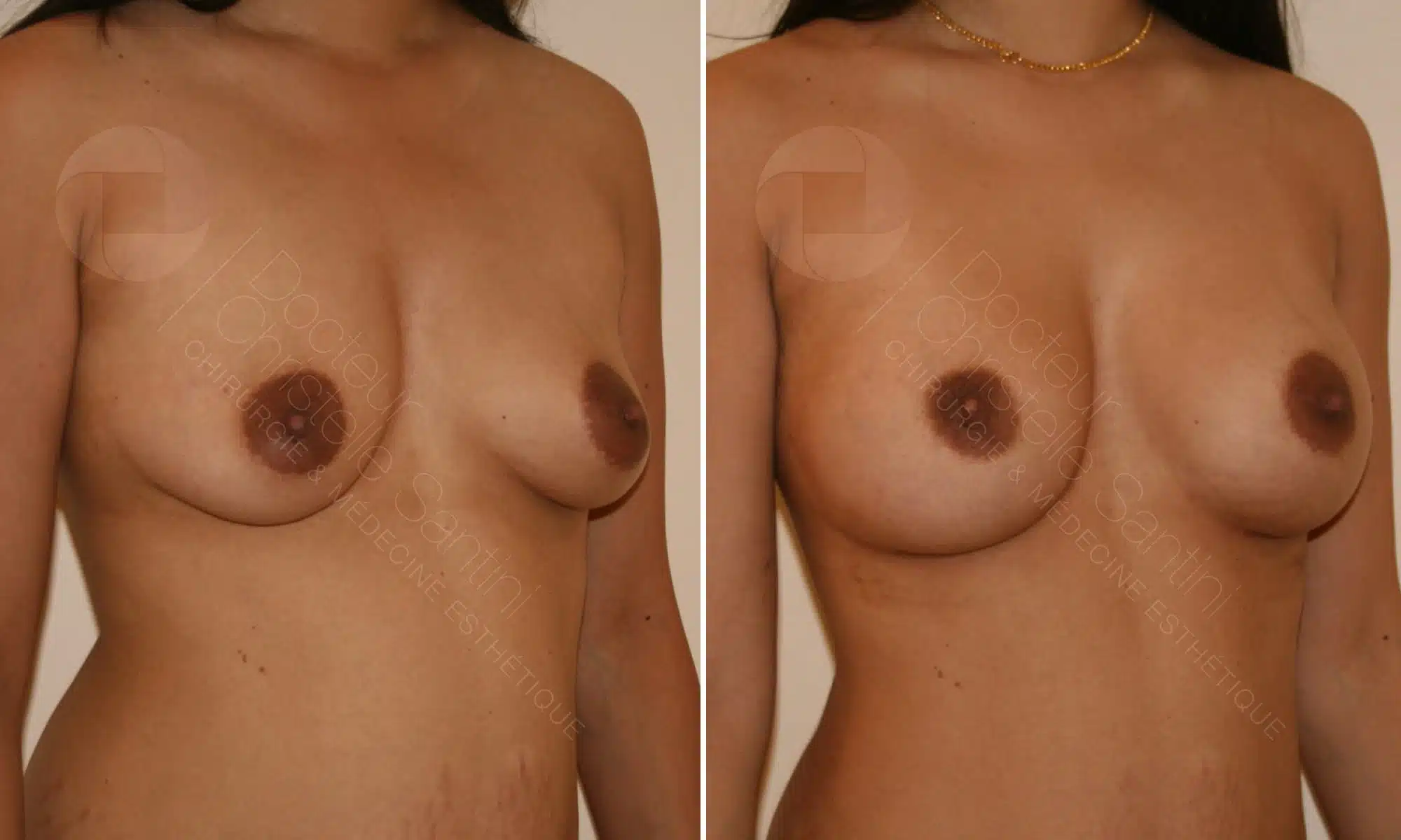 Photo de profile droit d une poitrine d une jeune femme avant/apres une augementation mammaire | Dr Santini Paris 16