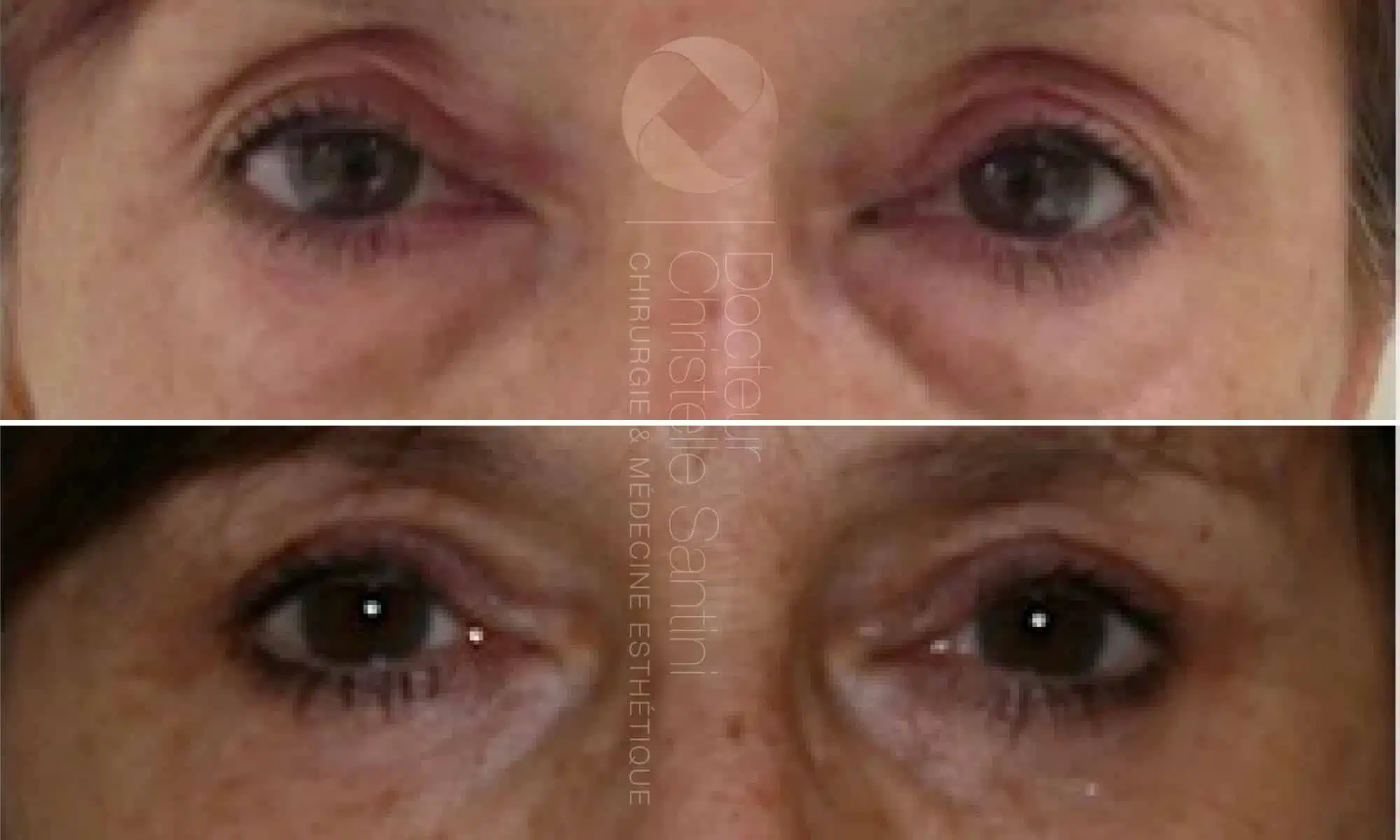 Image des yeux d une femme avant/apres blepharoplastie | Dr Santini Paris 16