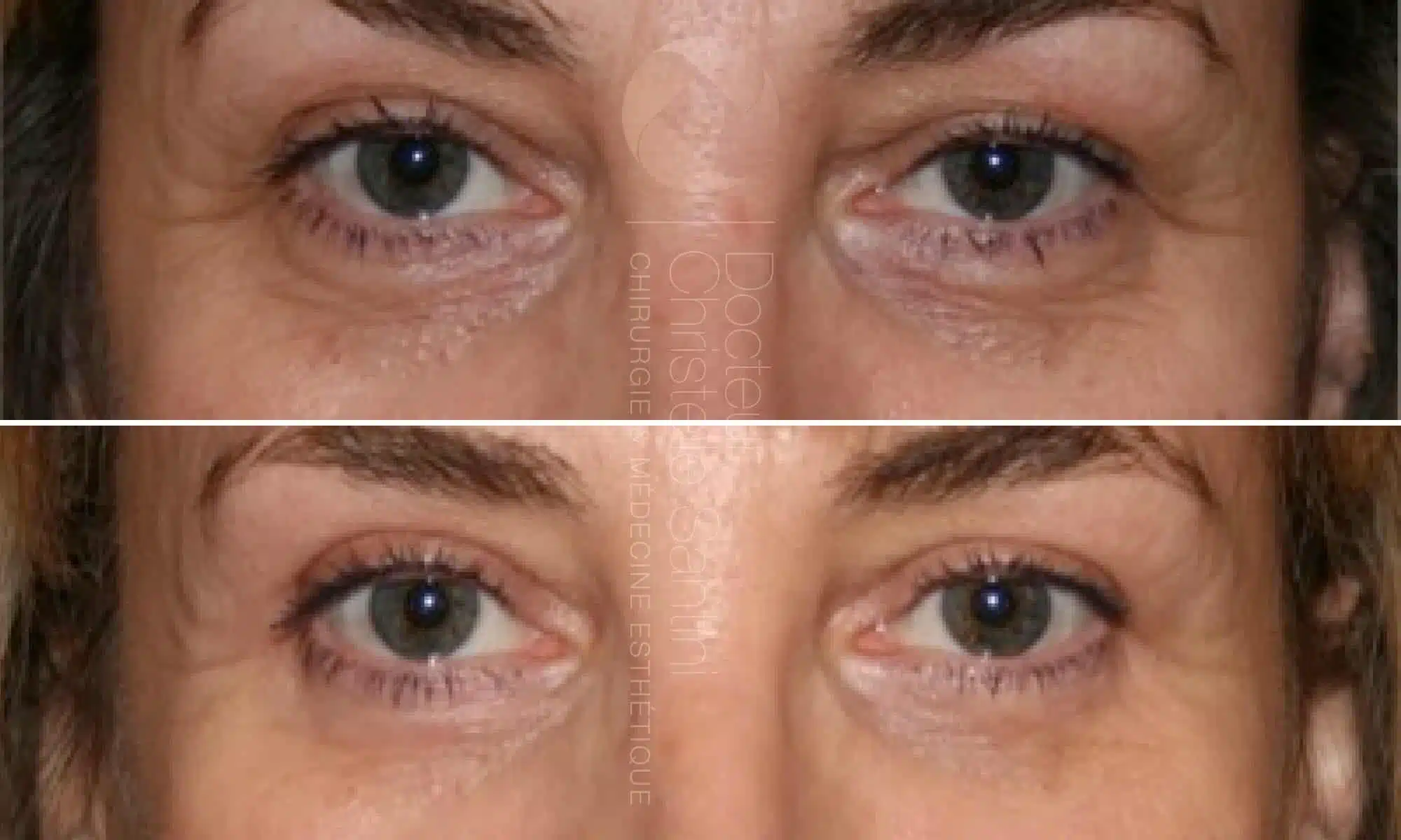 Image des yeux d une femme avant/apres blepharoplastie | Dr Santini Paris 16