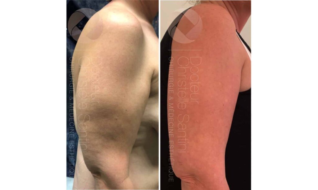 Liposuccion Avant/Après Dr Christelle Santini Paris