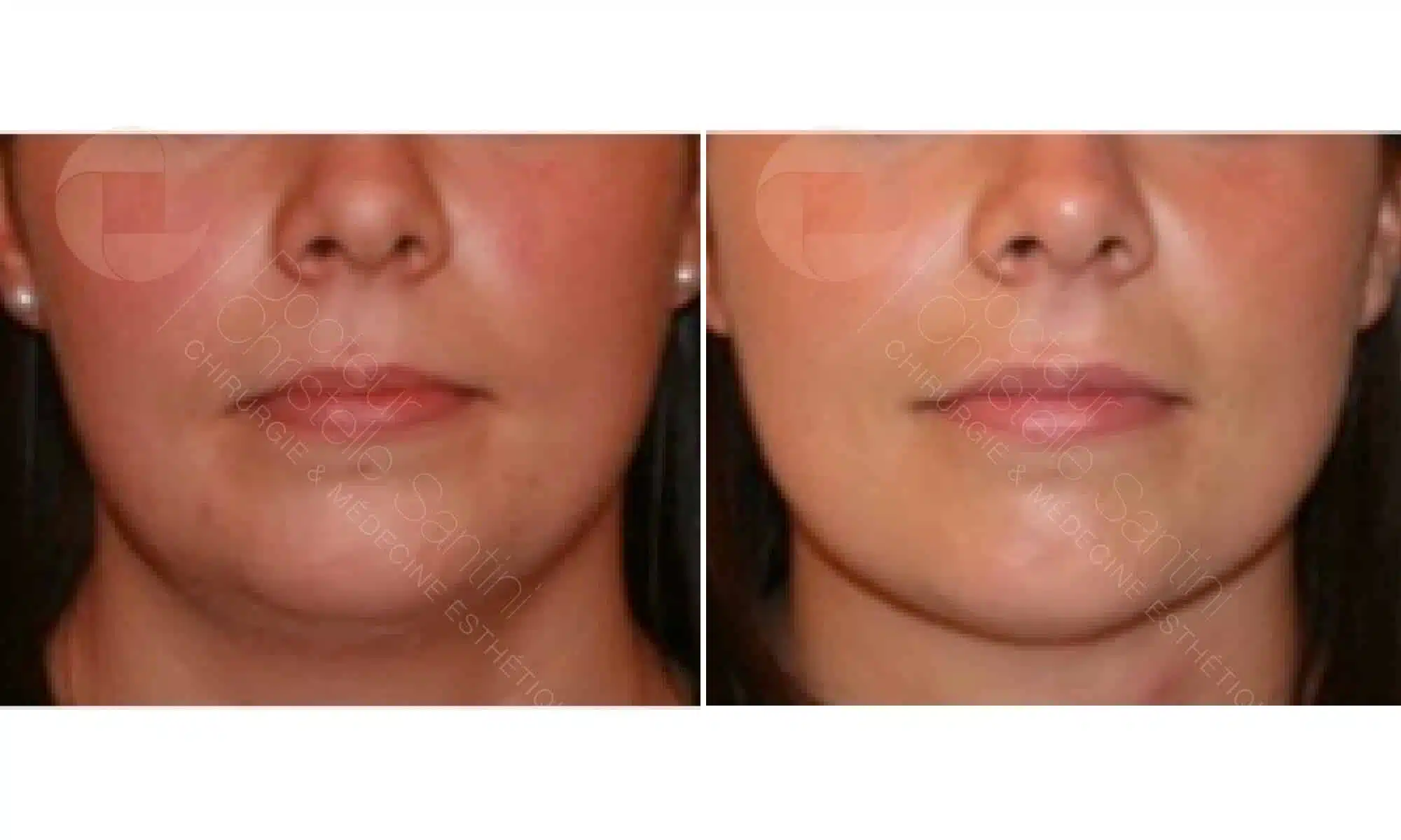 Vue rapprochee de profile face du visage d une femme avant/apres liposuccion du cou | Dr Santini Paris 16