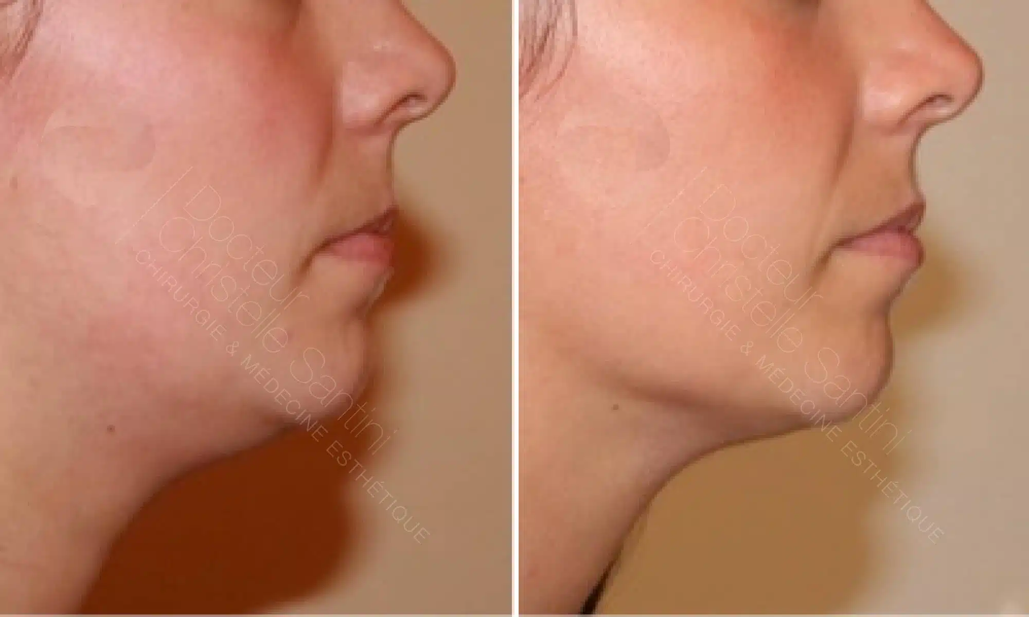 Vue rapprochee sur le visage d une femme avant/apres liposuccion du cou | Dr Santini Paris 16