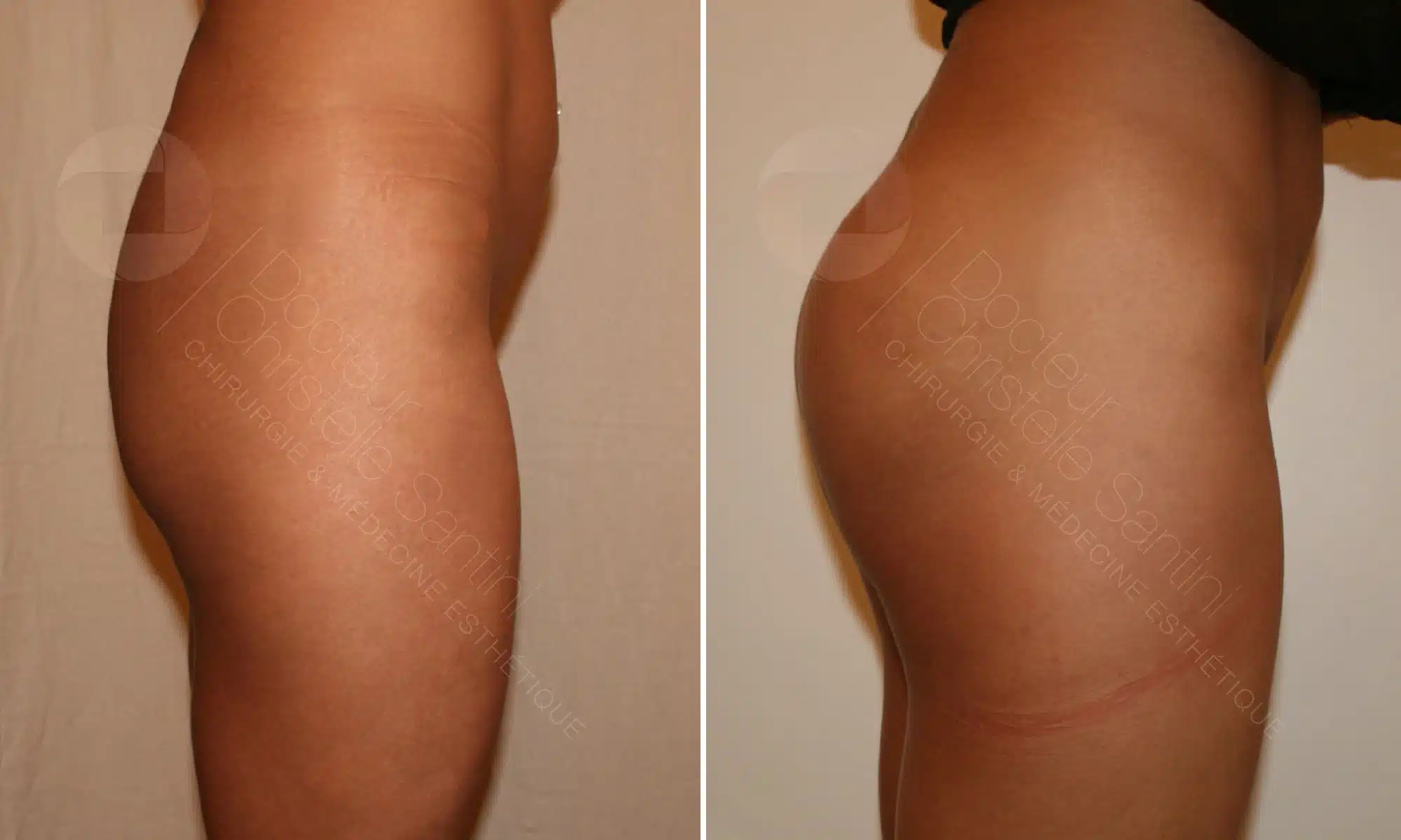 Fesses de femme de profile droit avant/apres lipofilling de fesses | Dr Santini Paris 16