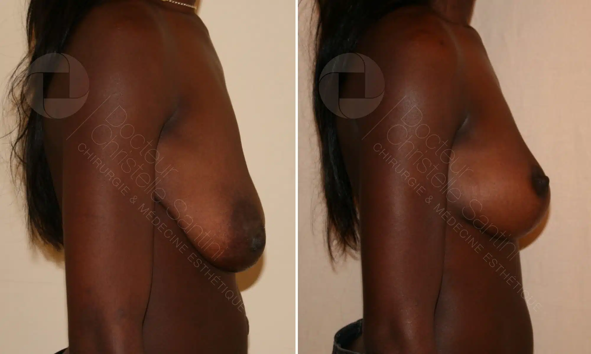 Photo de profile droit de la poitrine d une femme noire avants/apres correction ptose mammaire | Dr Santini Paris 16