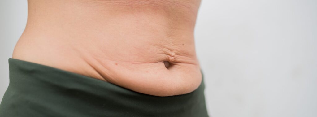 Relâchement cutané du ventre : que faire | Dr Santini