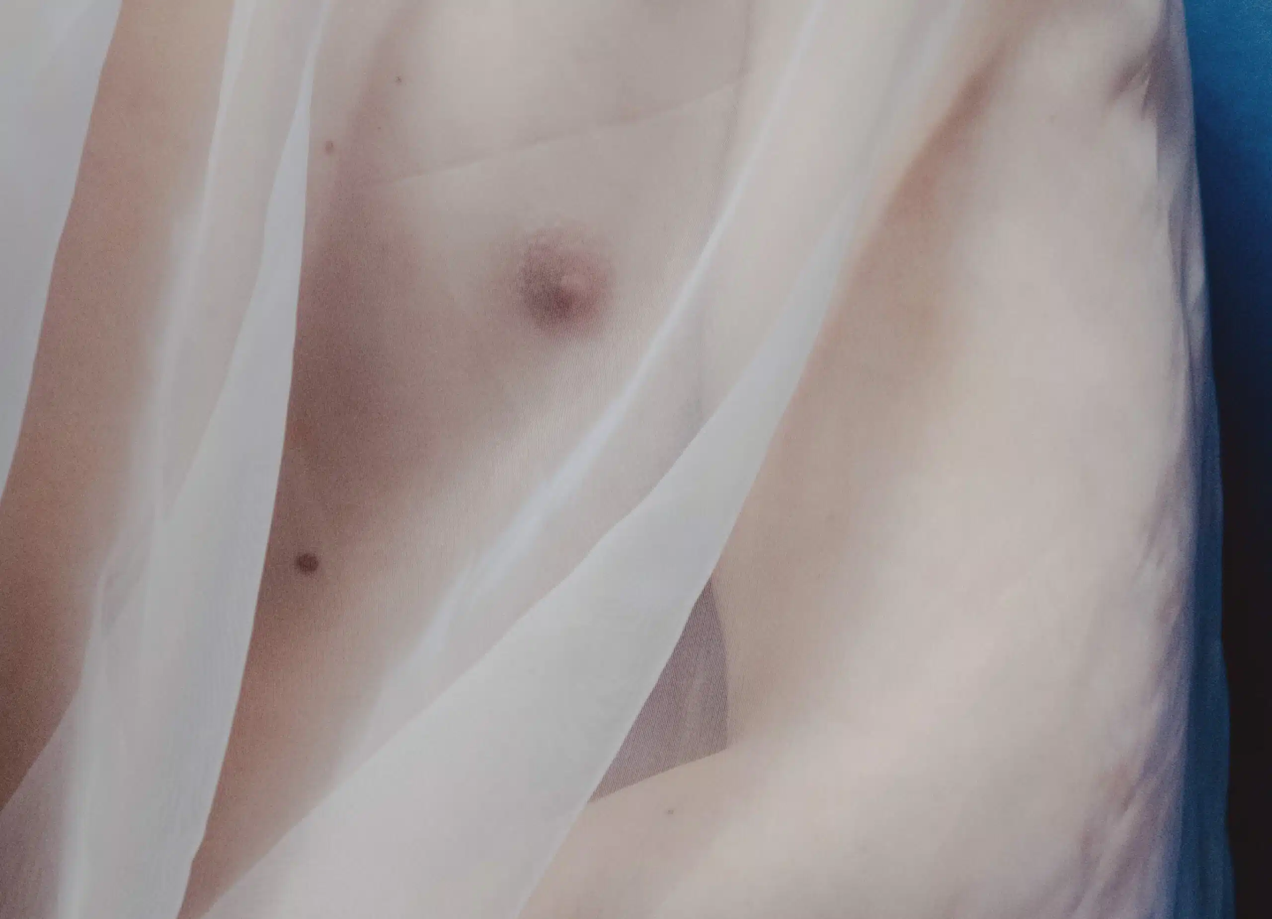 Gynécomastie à Paris | Chirurgie gynécomastie | Chirurgie esthétique | Dr Christelle Santini