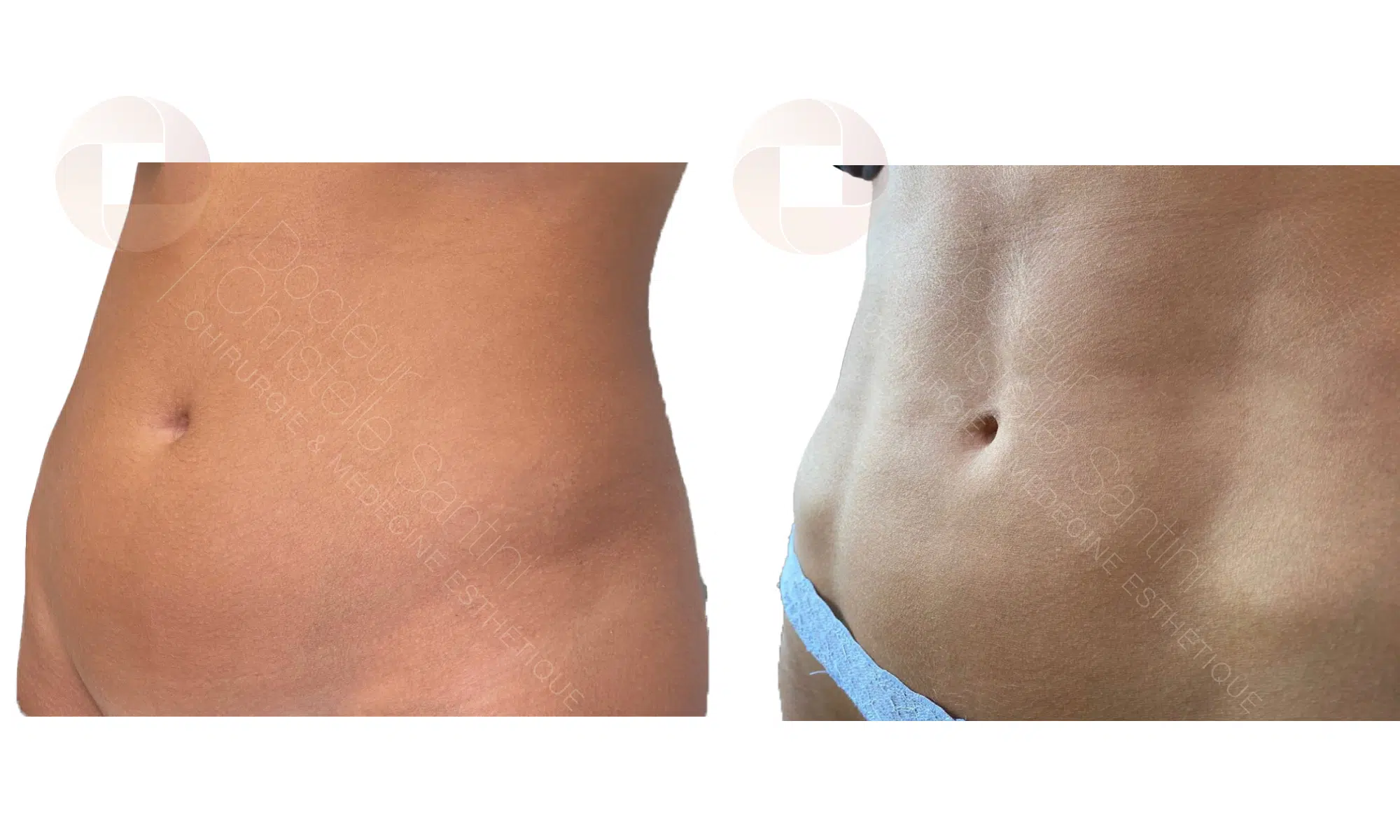 Liposuccion Haute Tension | Dr Santini | Paris