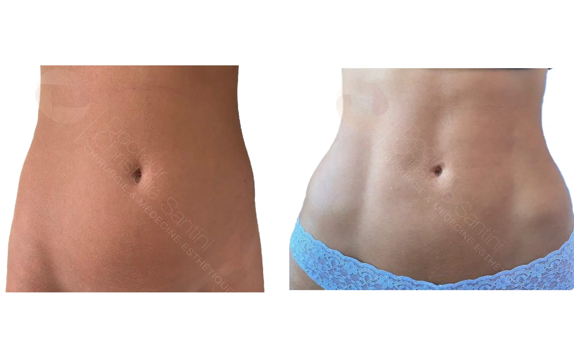 Liposuccion | Docteur Christelle Santini | Paris