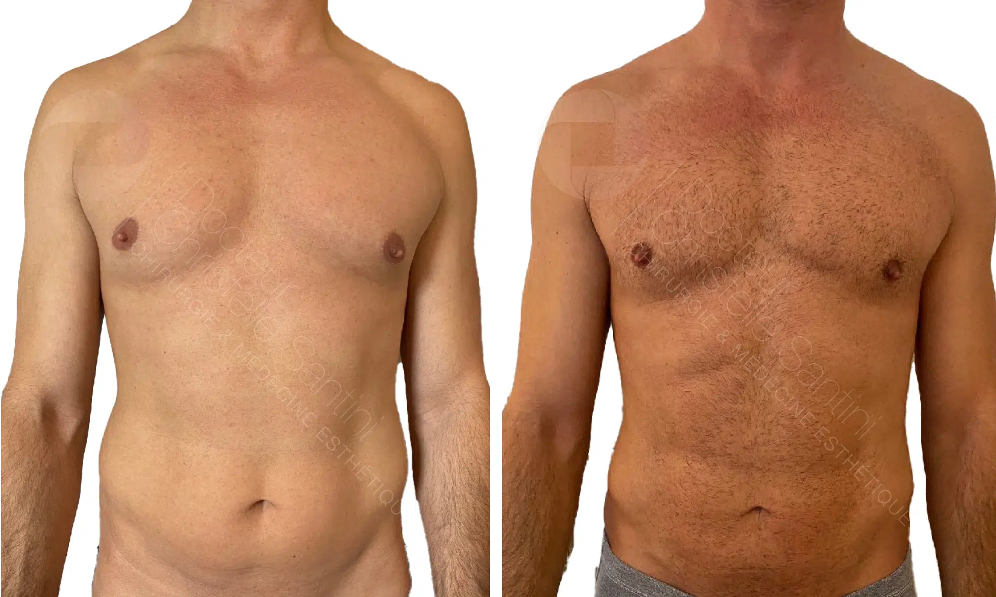 Liposuccion Vaser | photo avant/apres | Dr Santini | Paris