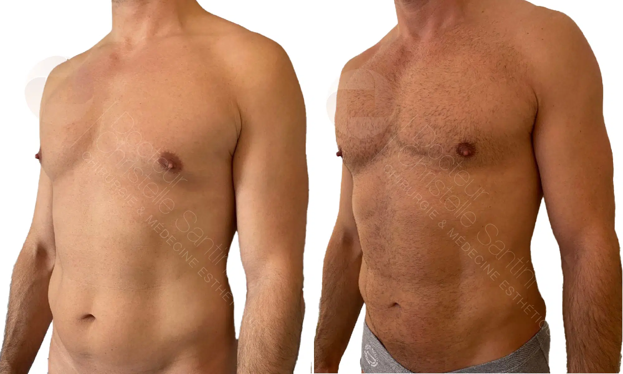 Lipofilling vaser | Dr Santini | Paris