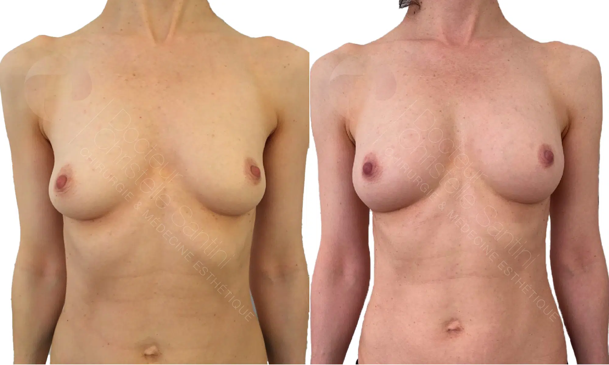 Lipofilling mammaire | Dr Santini | Paris