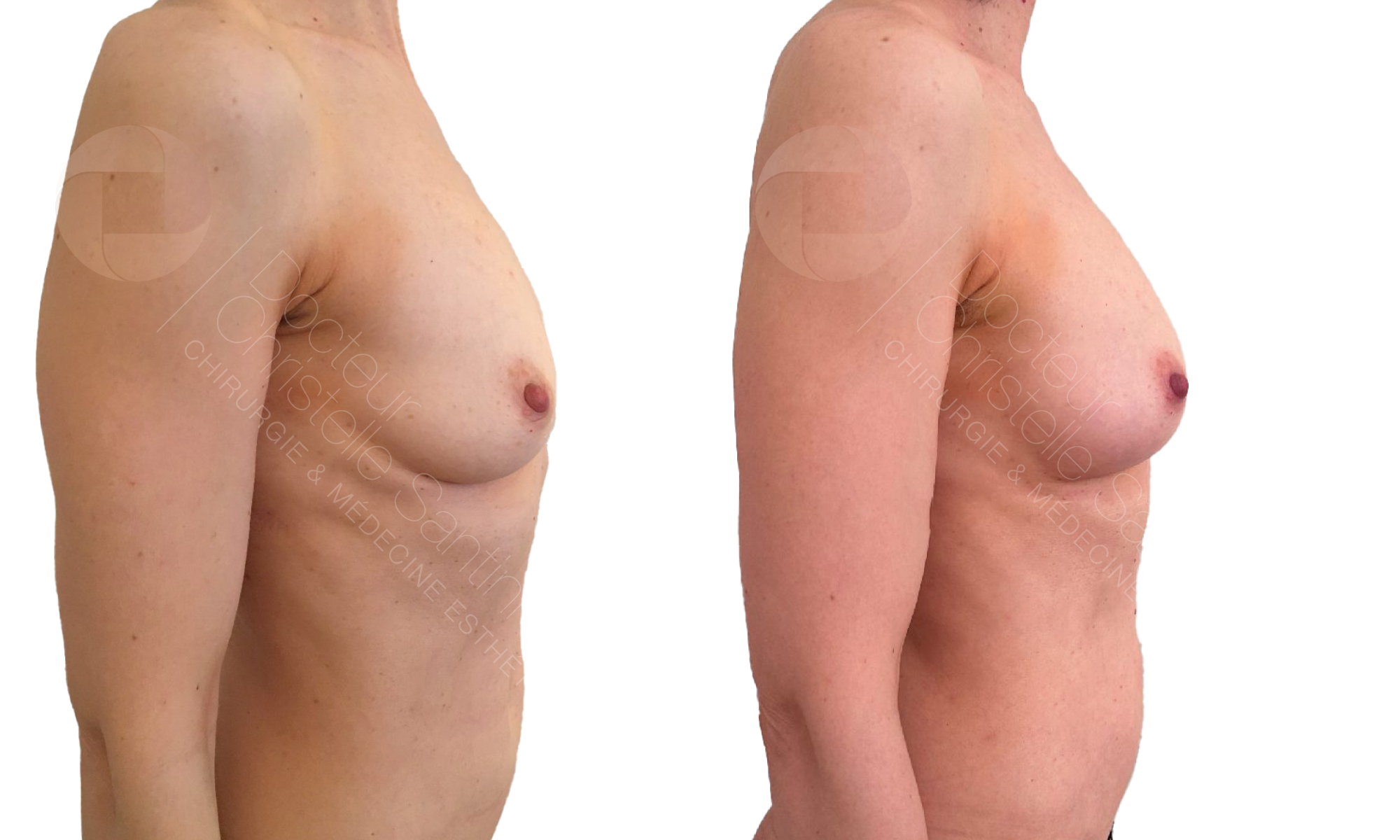 Augmentation mammaire par lipofilling | Dr Santini | Paris