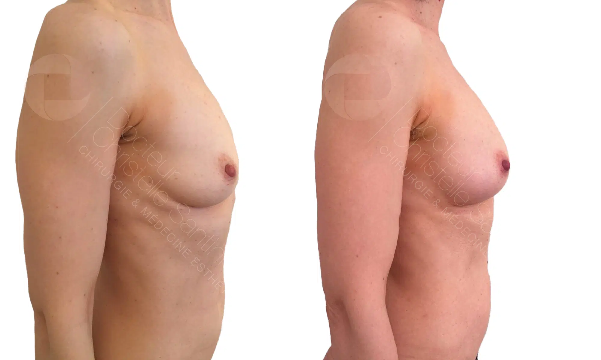 Augmentation mammaire par lipofilling | Dr Santini | Paris