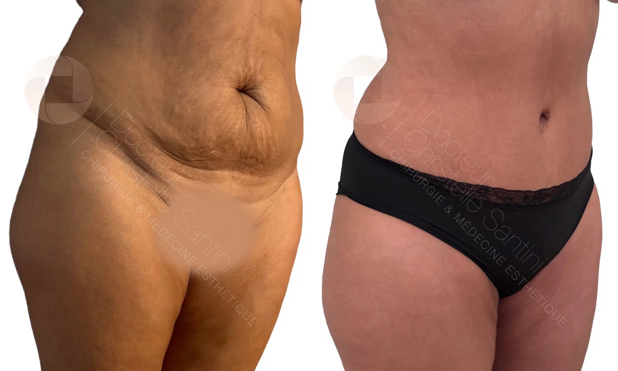 Abdominoplastie avant/apres | Dr Santini | Paris 16