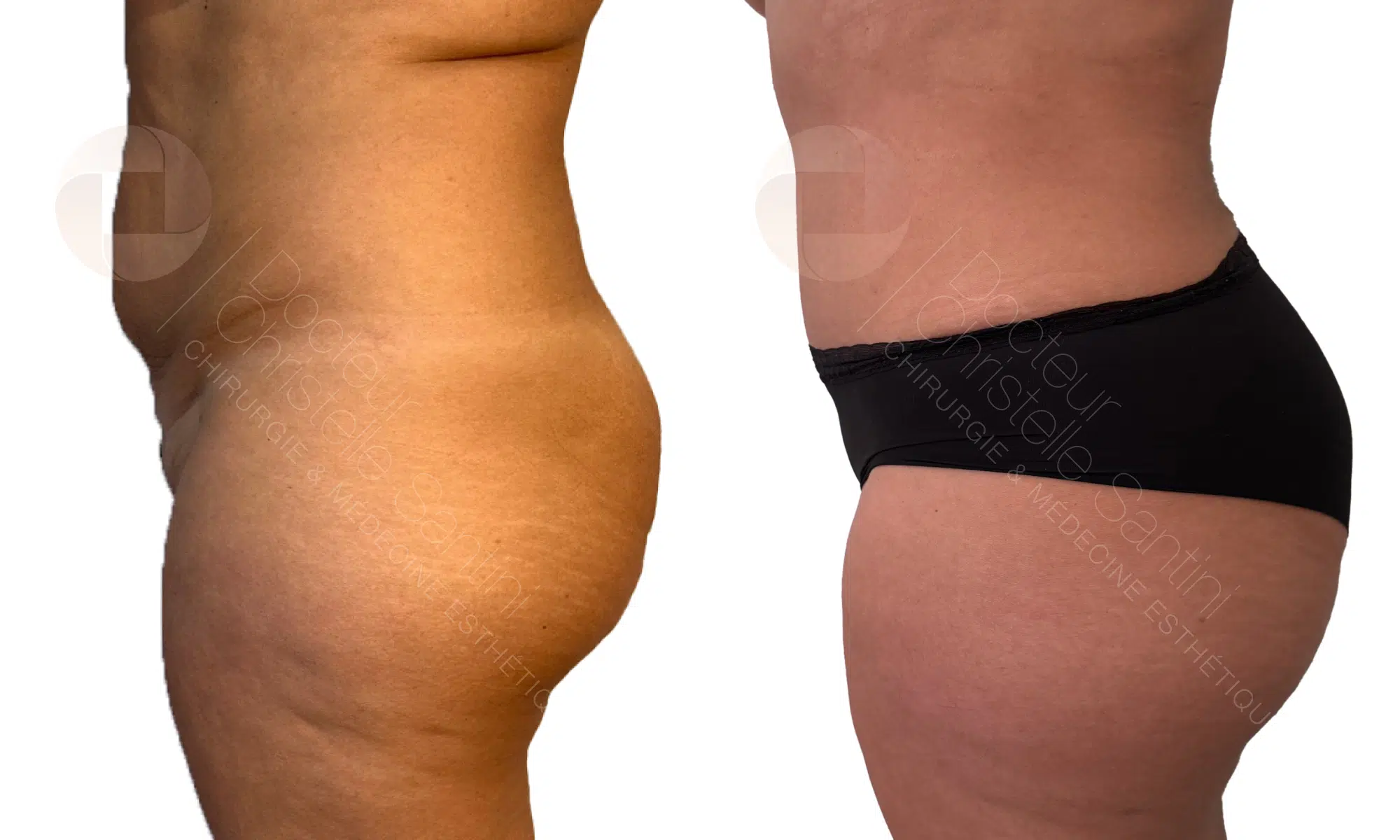 Photos avant/apres suite a une abdominoplastie | Dr Santini | Paris 16