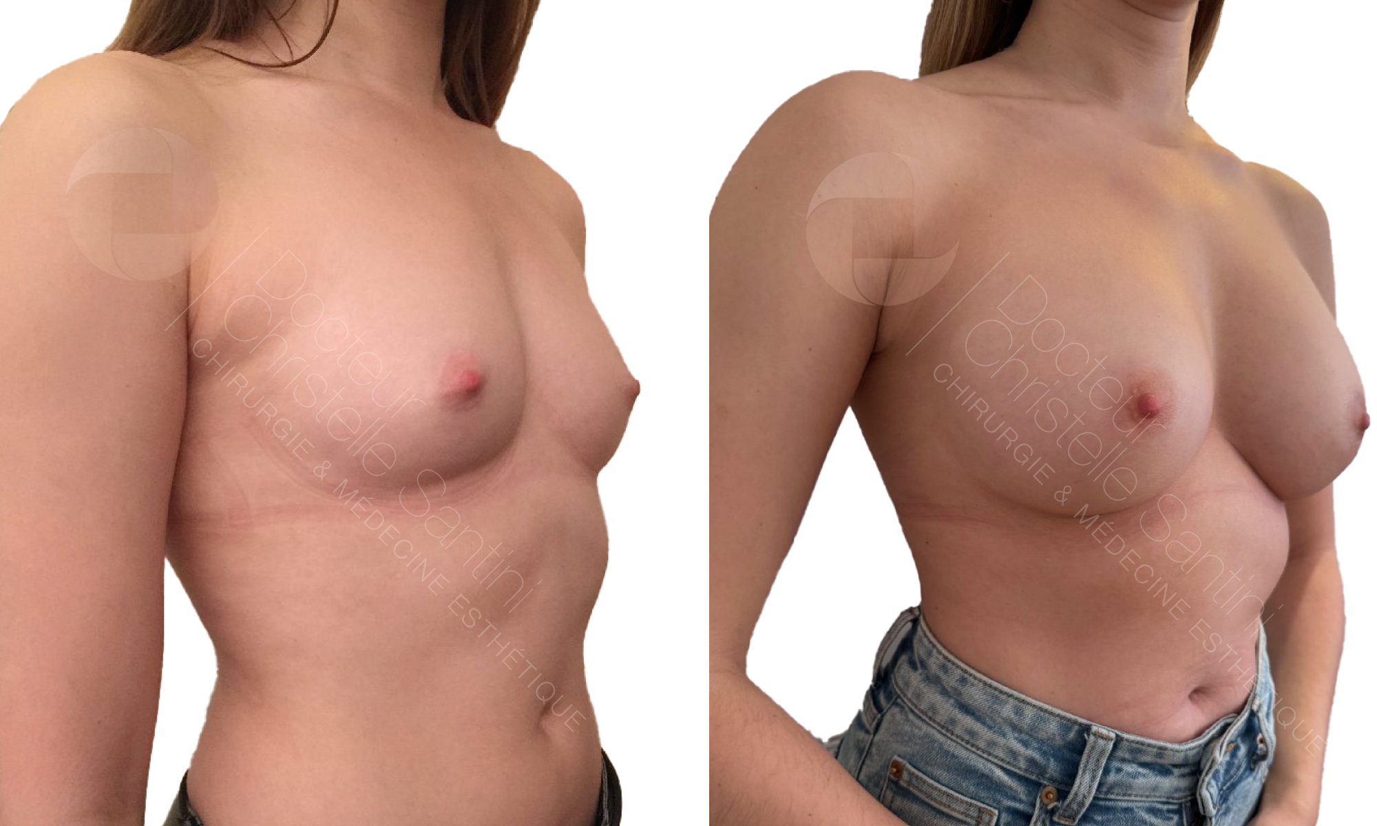 Augmentation mammaire | Dr Santini