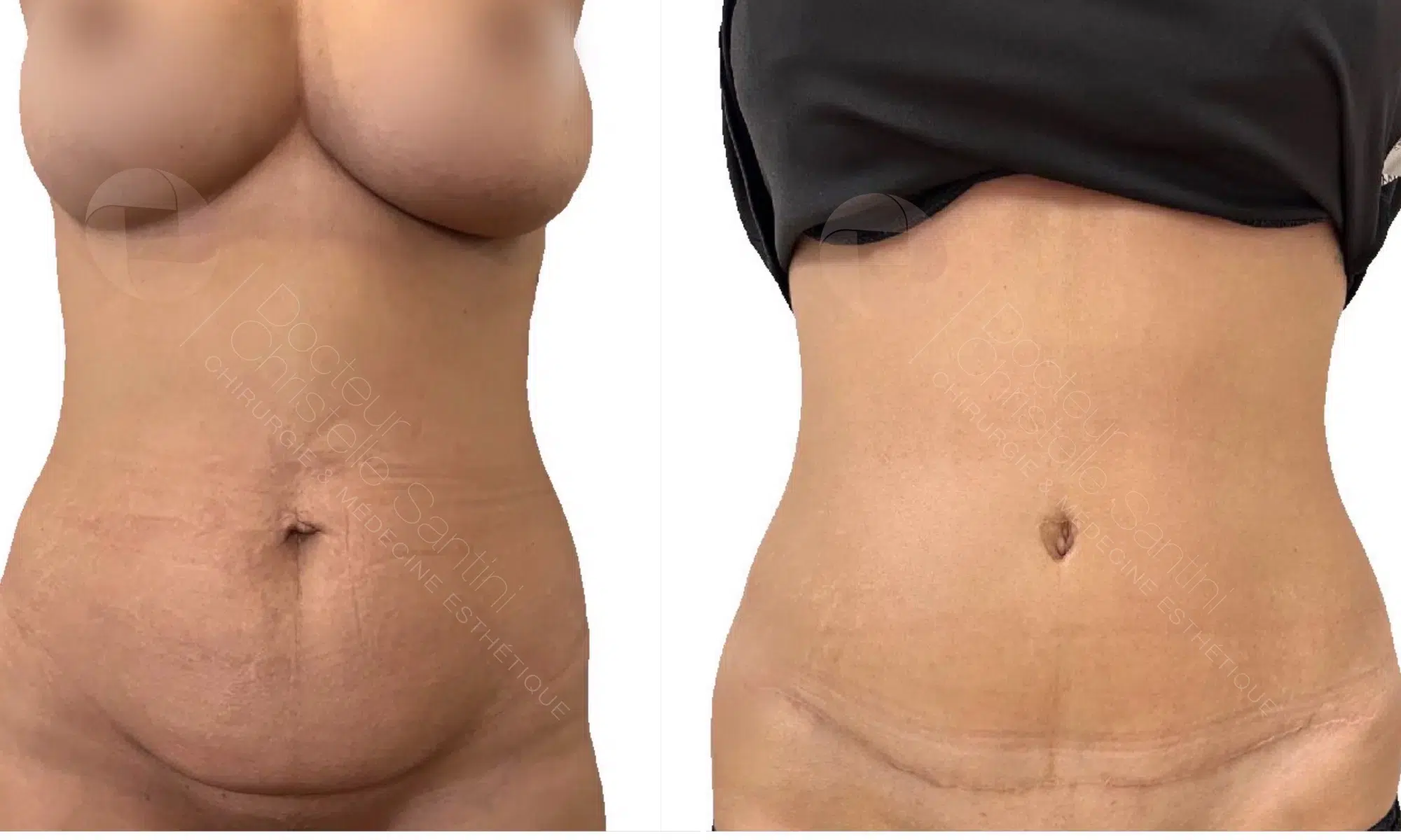 Image de profil face du ventre et poitrine d une femme avant/apres abdominoplastie | Dr Santini Paris 16