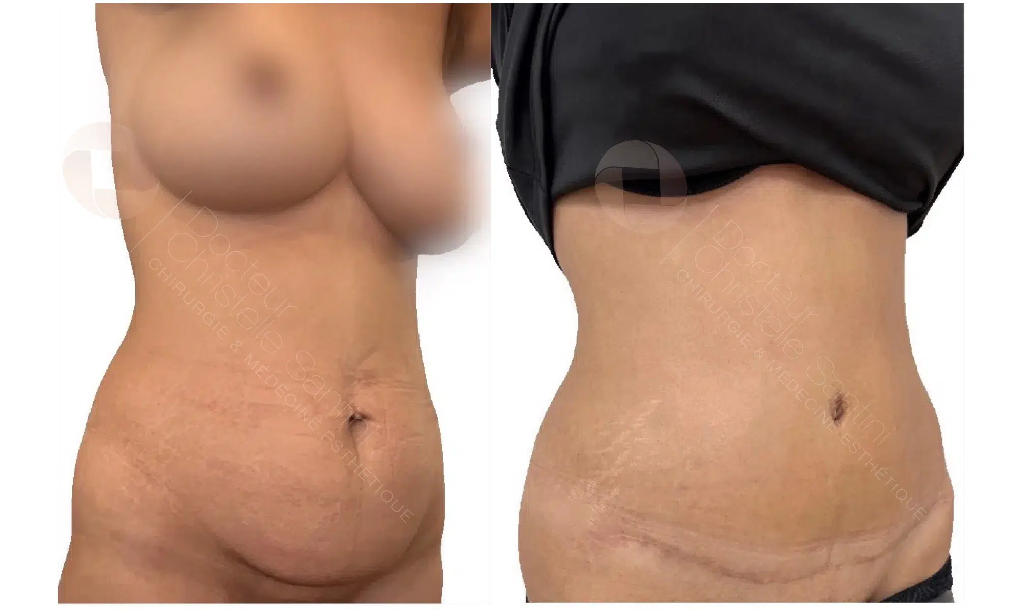 Image de profil face du ventre et poitrine d une femme avant/apres abdominoplastie | Dr Santini Paris 16