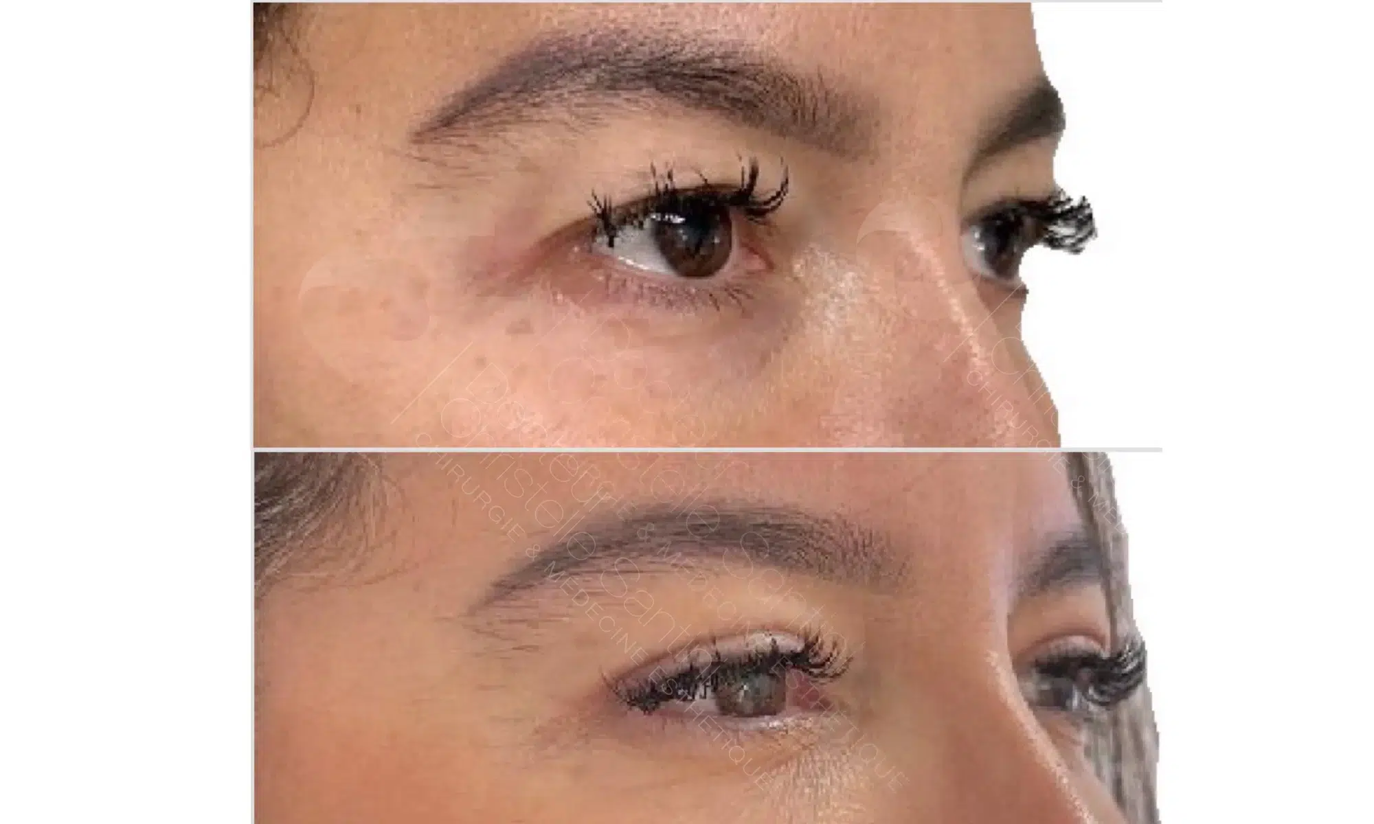 Image de profile droit des yeux d une femme avant/apres blepharoplastie | Dr Santini Paris 16