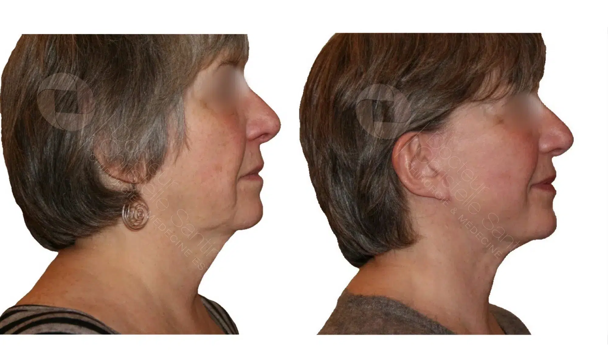 Image de profile droit du visage d une femme avant/apres lifting cervico facial | Dr Santini Paris 16