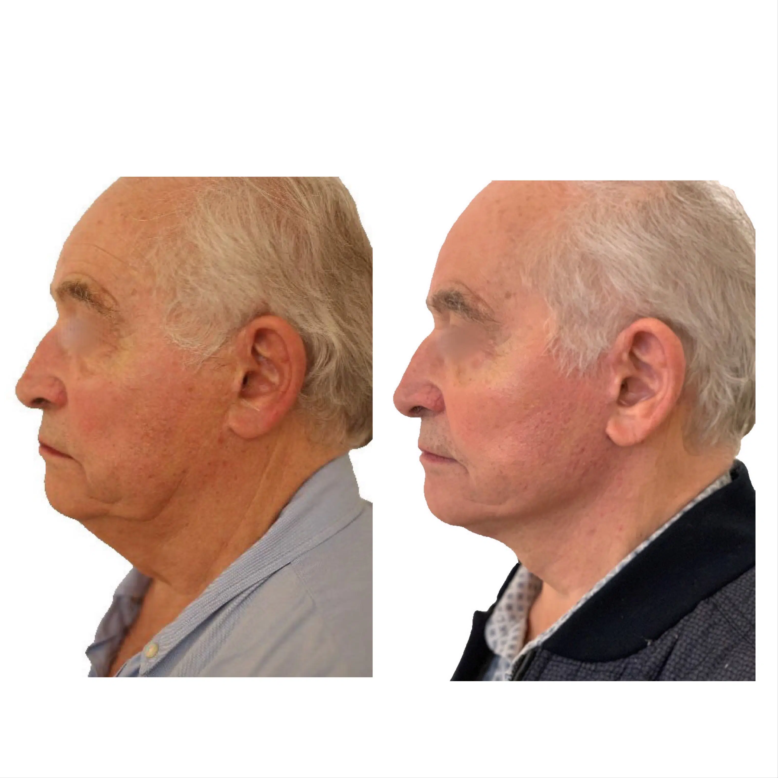 Image de profil gauche du visage d un homme avant/apres lifting cervico facial | Dr Santini Paris 16