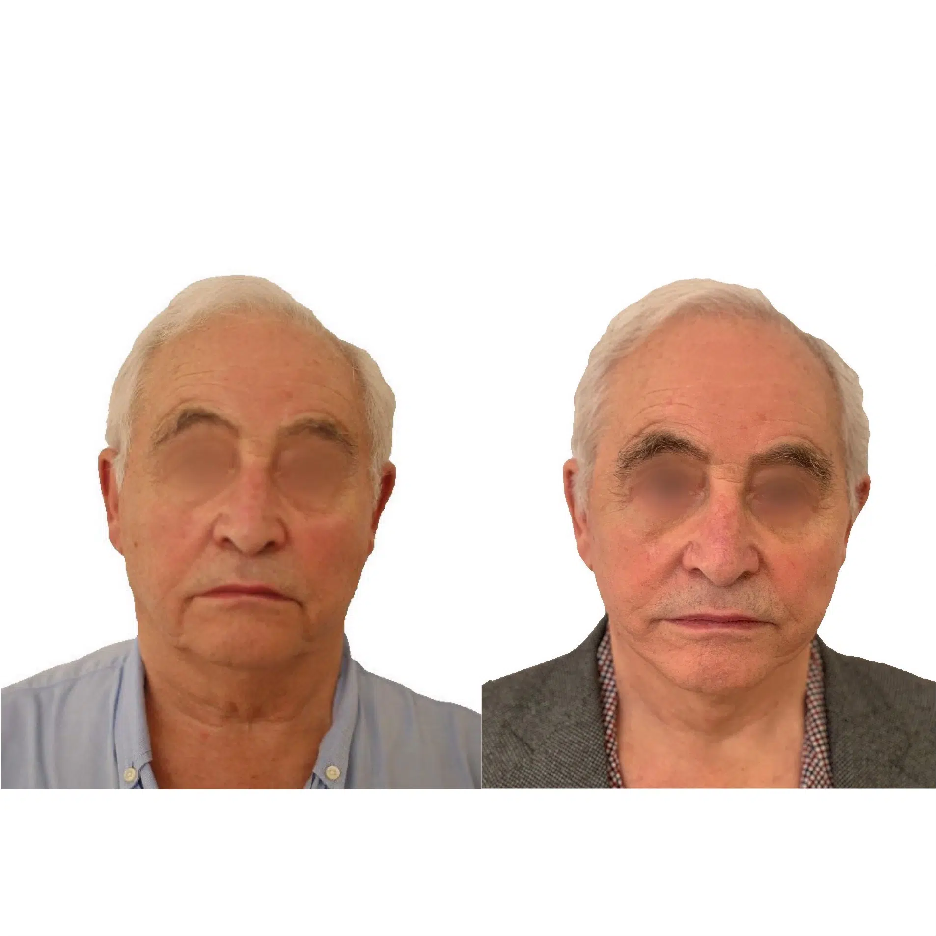Image de profil face du visage d un homme avant/apres lifting cervico facial | Dr Santini Paris 16