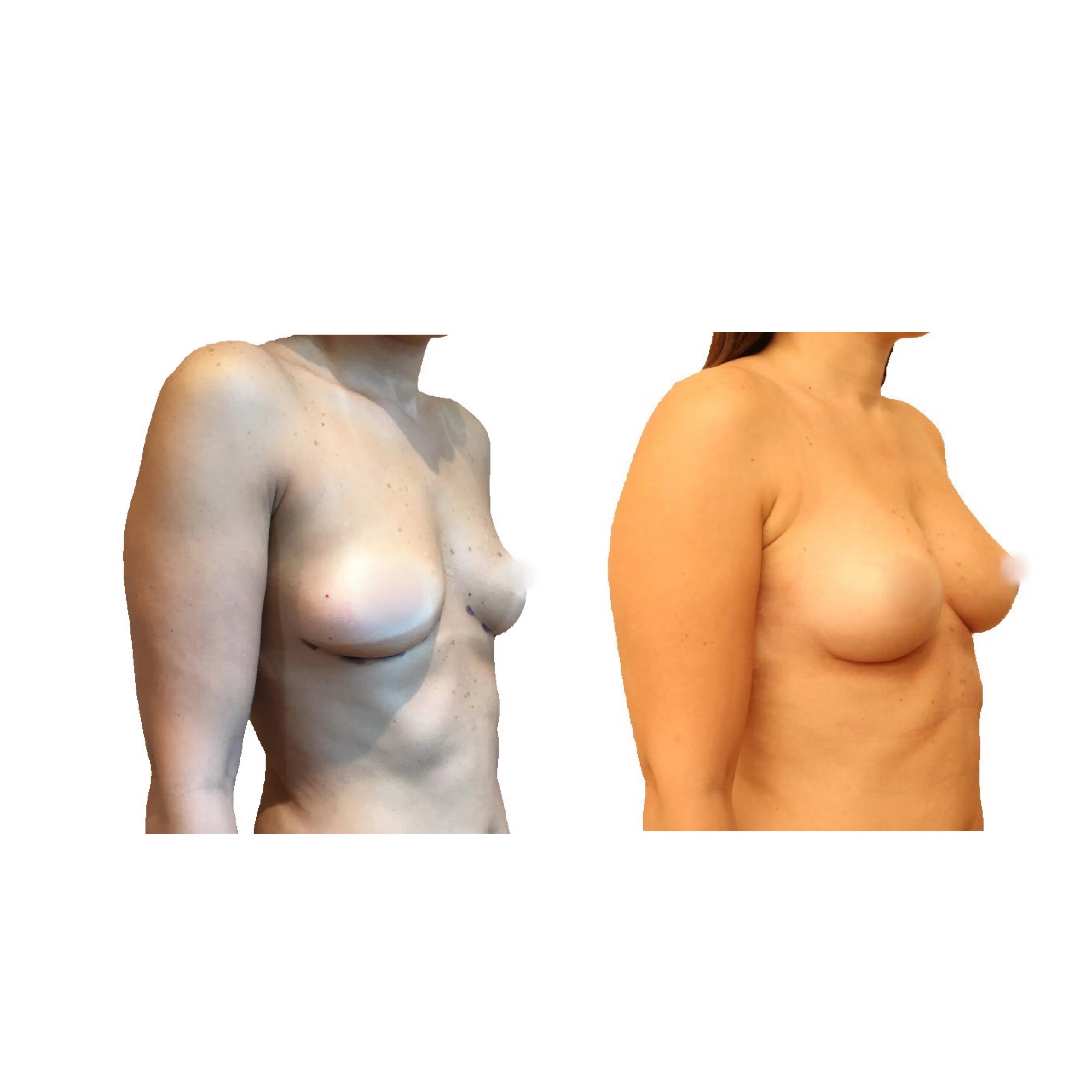 Poitrine de femme avant/apres lipofilling mammaire | Dr Santini Paris 16