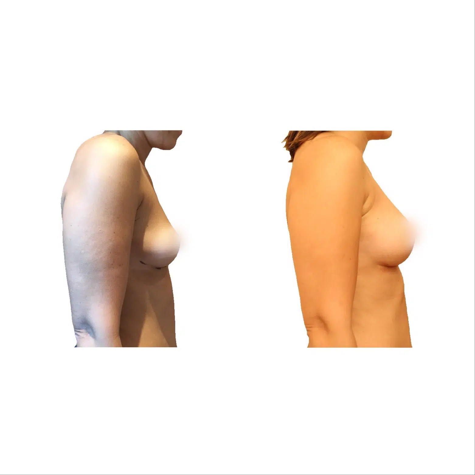 Poitrine de femme avant/apres lipofilling mammaire | Dr Santini Paris 16