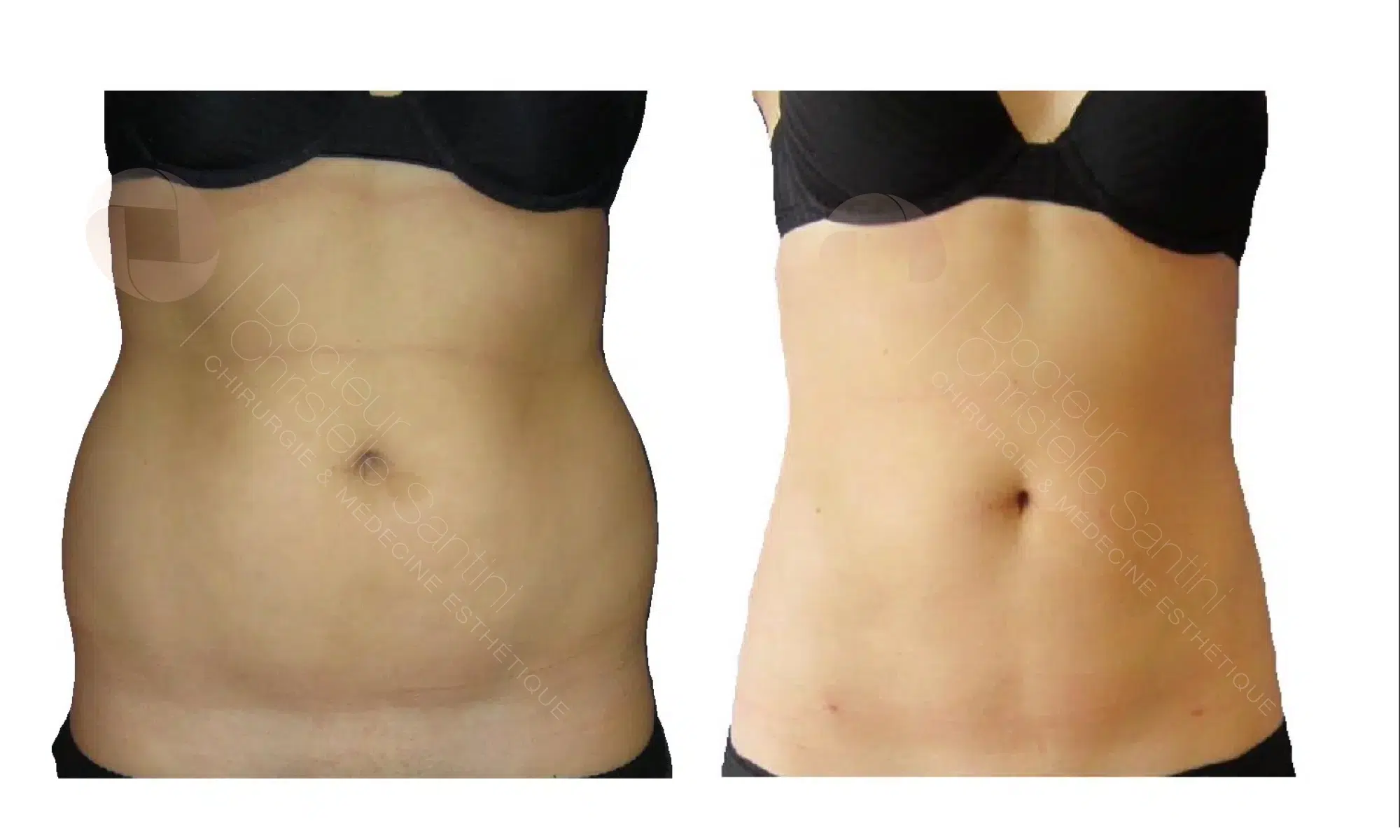 Photo de profile face du ventre et hanche d une femme avant/apres liposuccion du ventre et des hanches | Dr Santini Paris 16