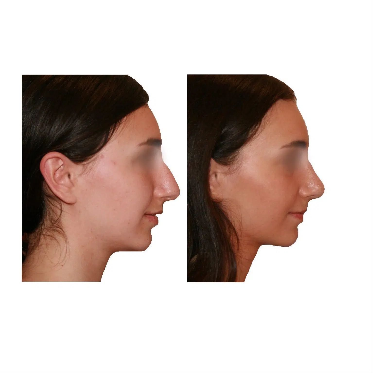 Image de profil droit du visage d une femme avant/apres rhinoplastie | Dr Santini Paris 16