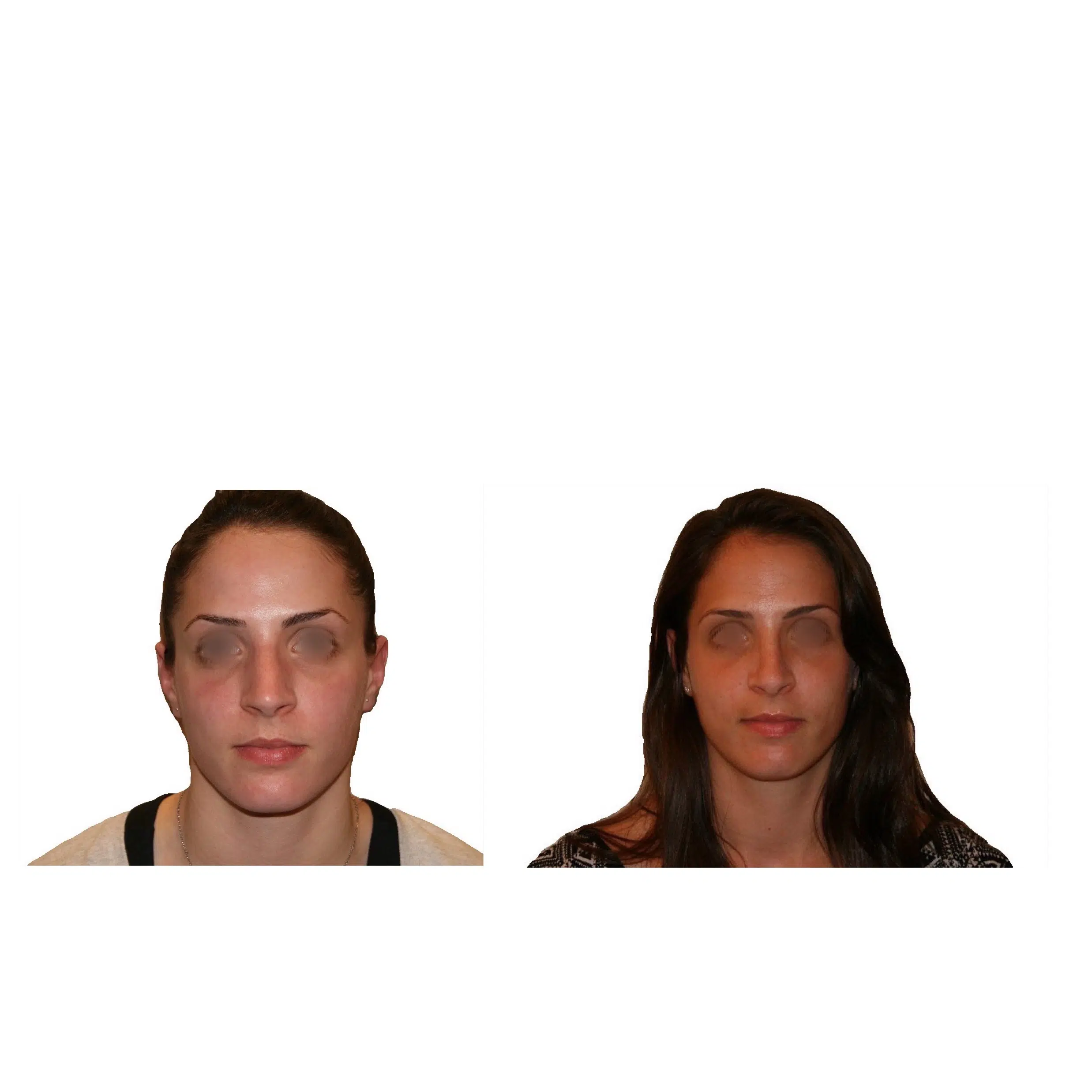 Image de profil face du visage d une femme avant/apres rhinoplastie | Dr Santini Paris 16