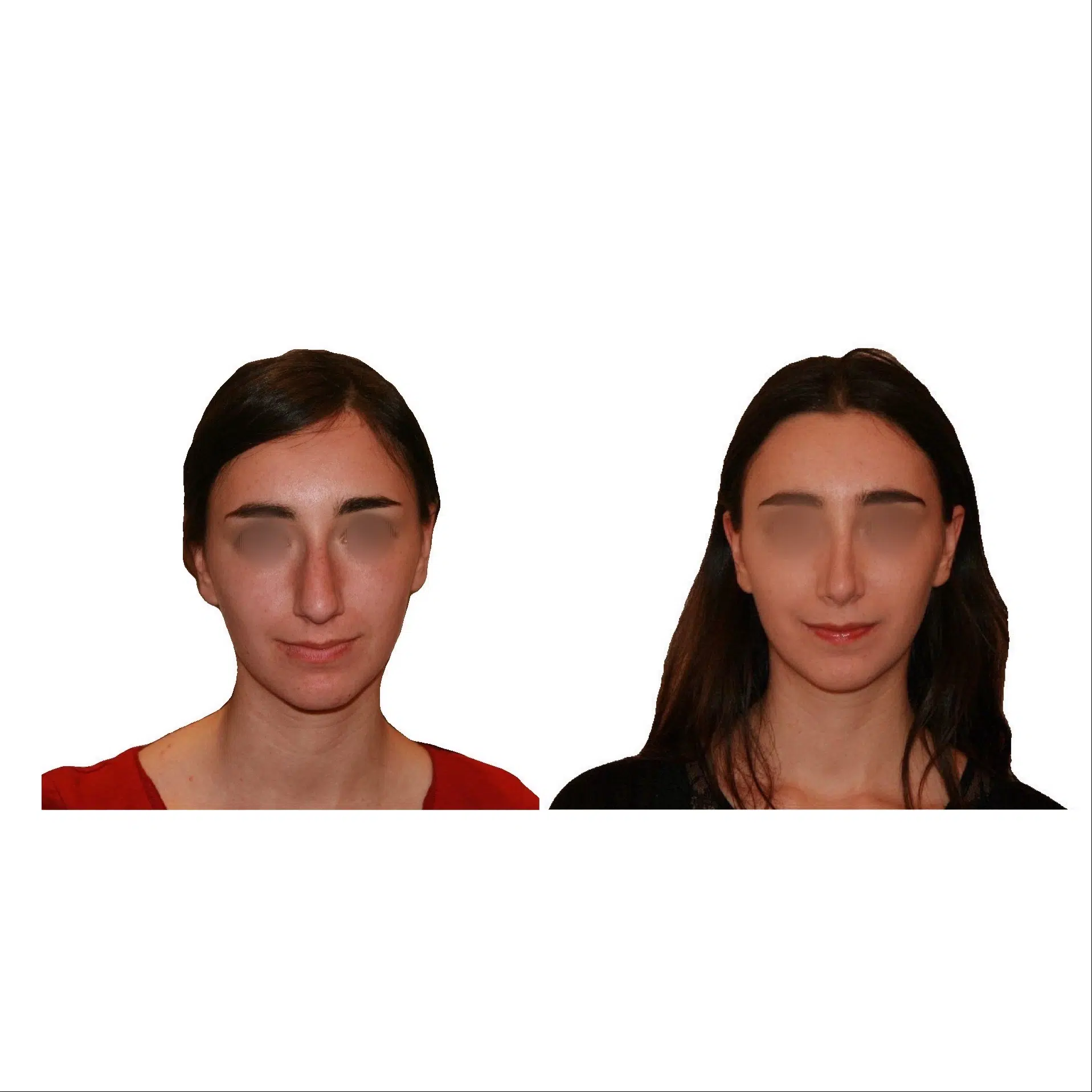 Image de profil face du visage d une femme avant/apres rhinoplastie | Dr Santini Paris 16