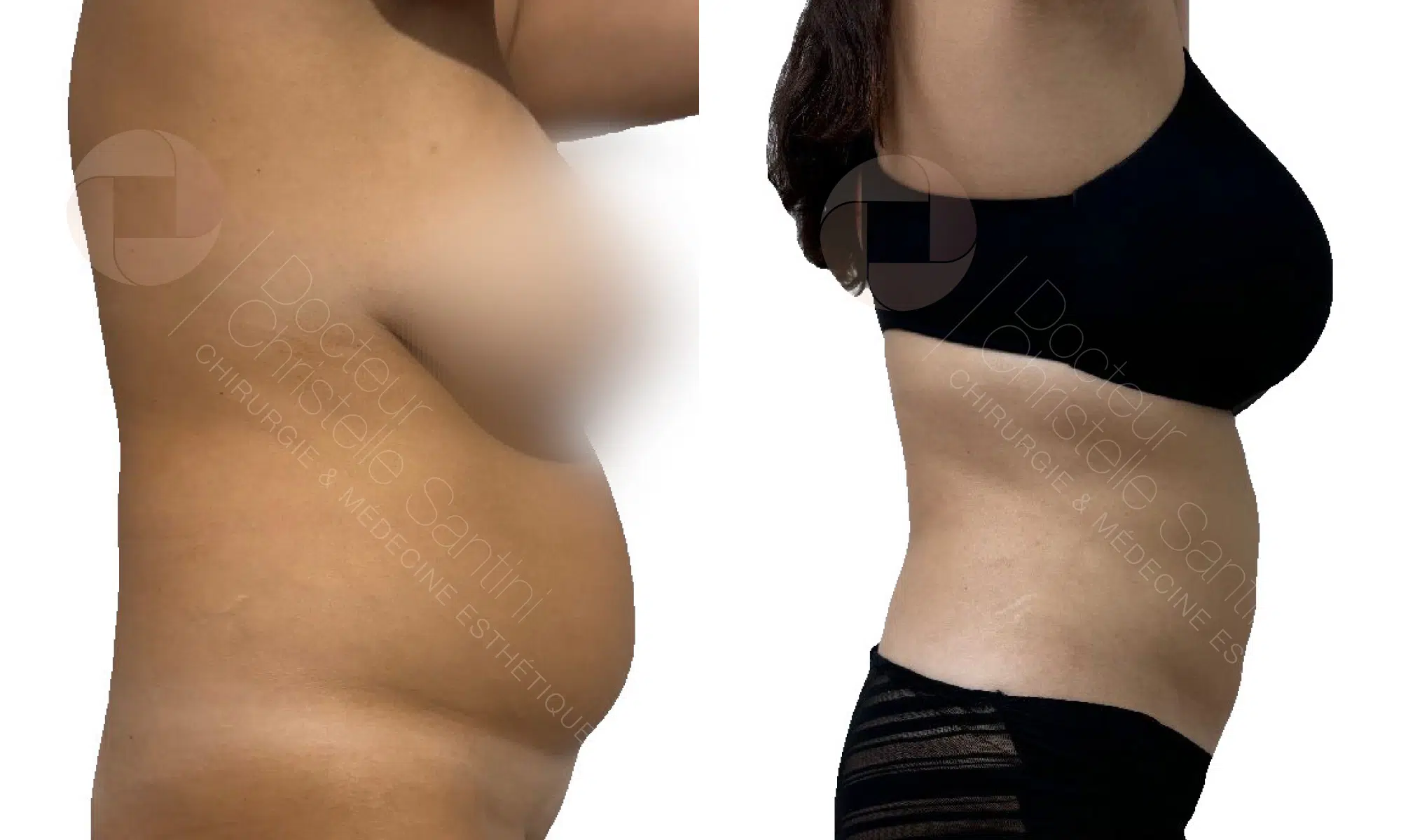 Photo de profile droit de la poitrine et ventre d une femme avant/apres une liposuccion haute definition par vaser | Dr Santini Paris 16