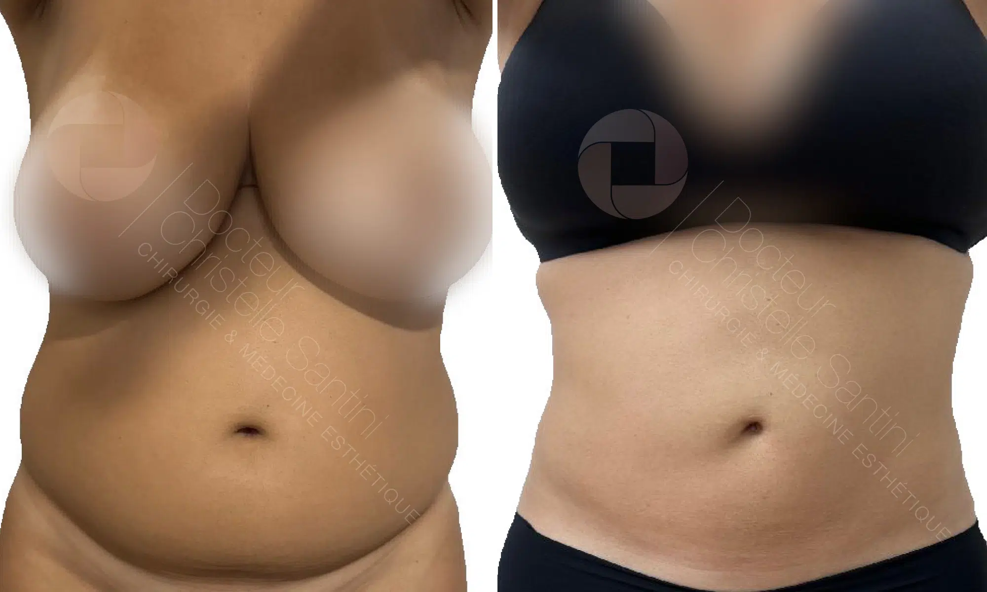 Poitrine et ventre d une femme avant/apres une liposuccion haute definition par vaser | Dr Santini Paris 16