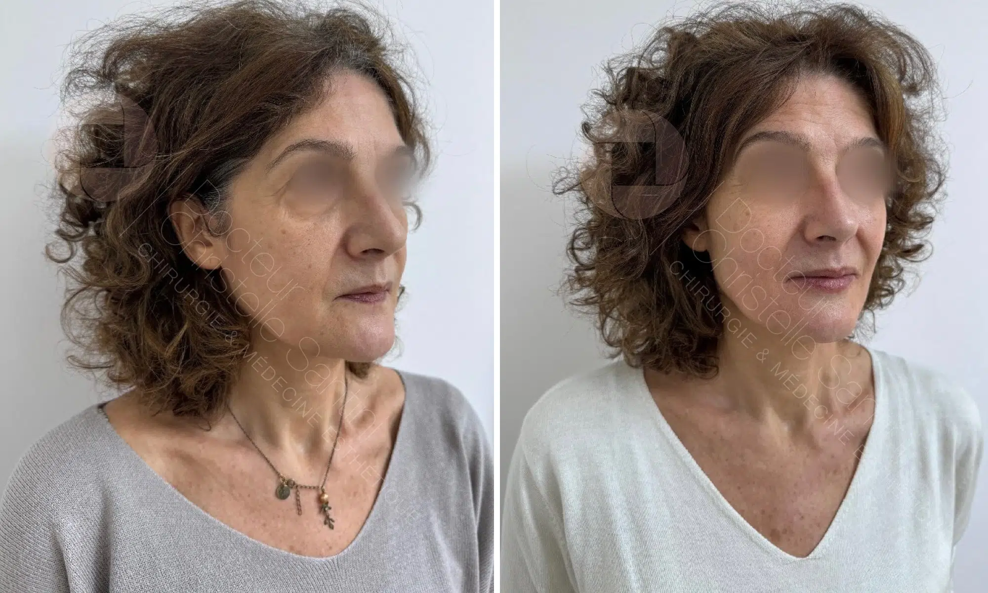 Image du visage d une femme d age moyen avant/apres rajeunissement visage | Dr Santini Paris 16