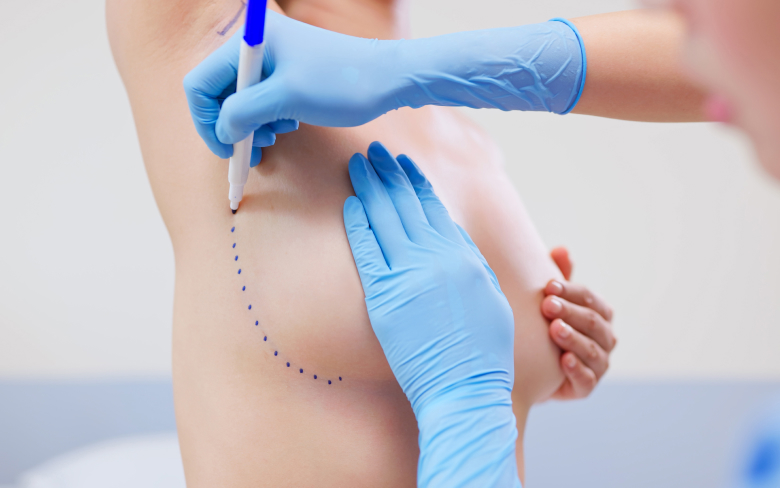 Augmentation mammaire lipofilling | Dr Christelle Santini | Paris