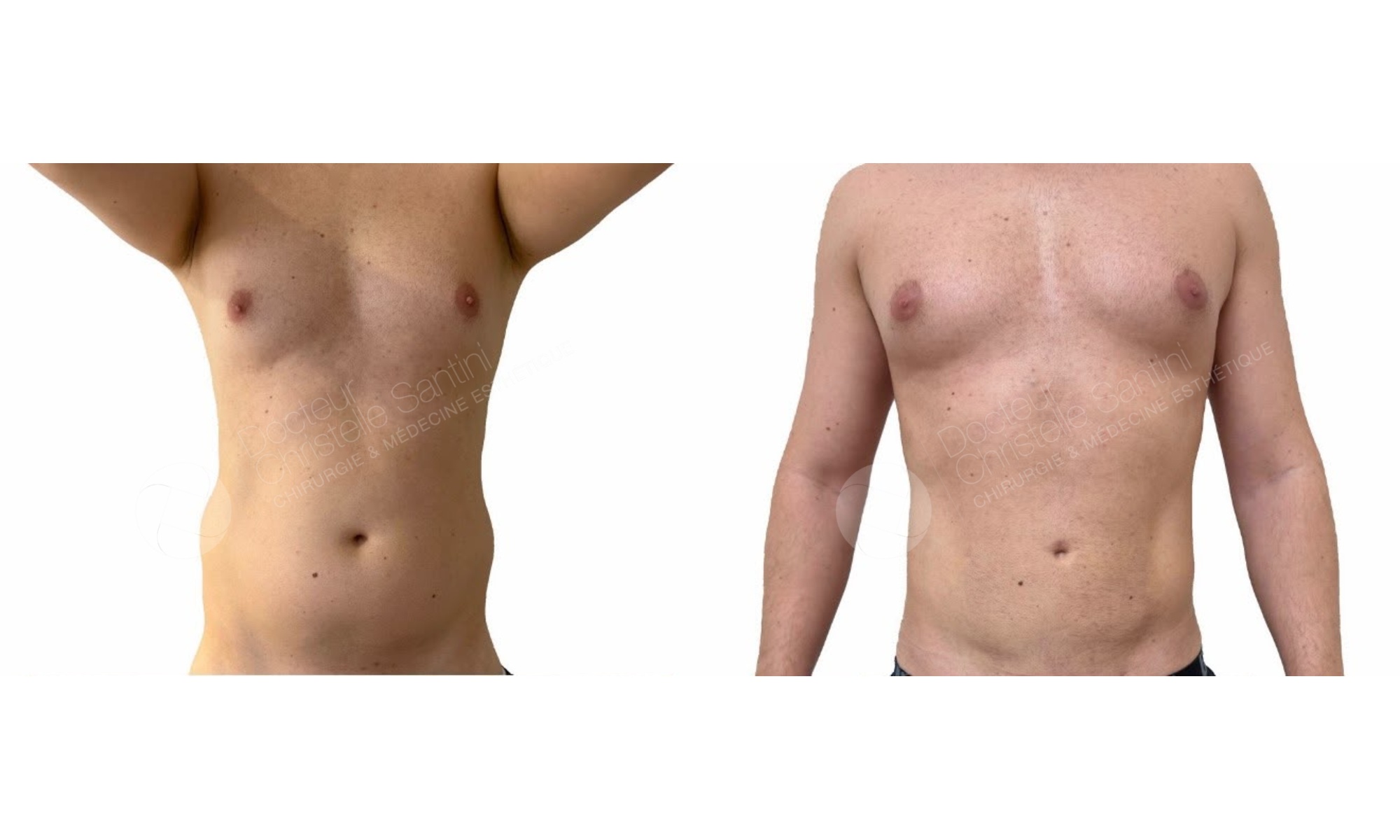 Before and after photos of a man’s VASER high-definition liposuction of the abdomen, performed by Dr. Christelle Santini in Paris