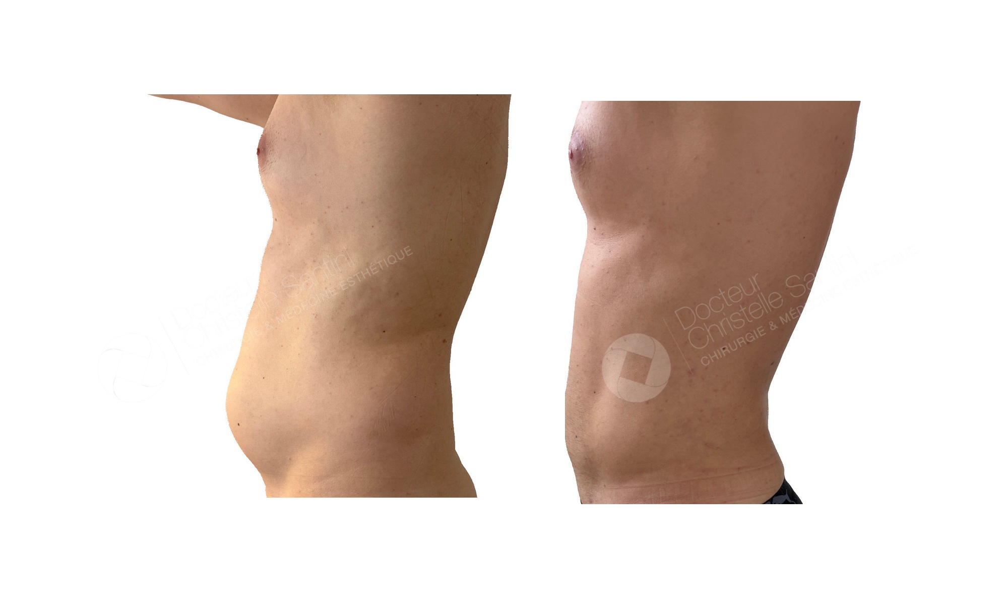 Before and after photos of VASER high-definition liposuction of the abdomen in a male patient, viewed from the side, performed by Dr. Christelle Santini in Paris
