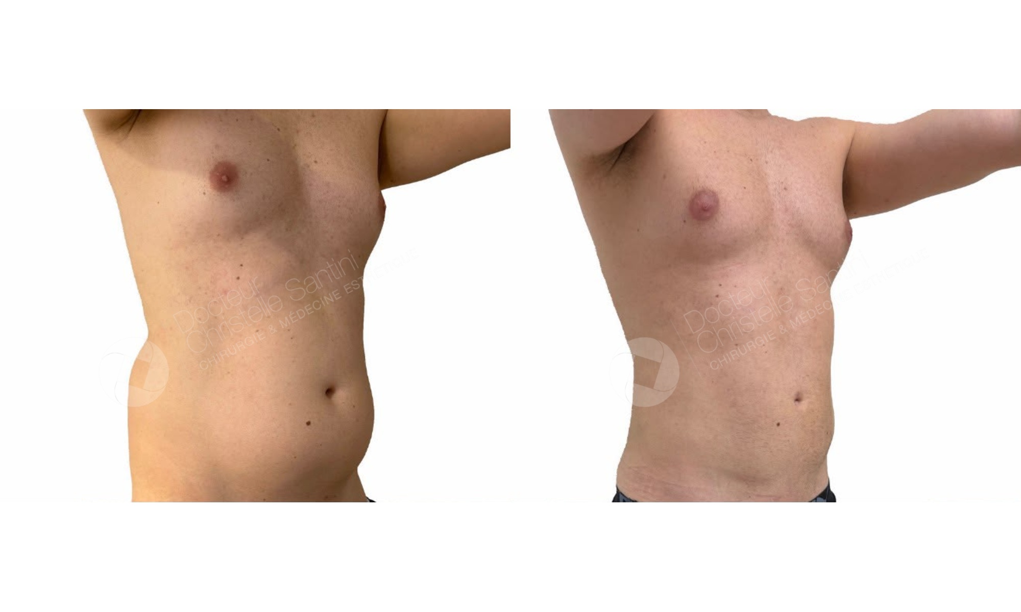 Before and after photos of a man who underwent VASER high-definition liposuction of the abdomen, three-quarter view, performed by Dr. Christelle Santini in Paris