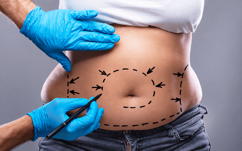 Marquages préopératoires sur l’abdomen avant une liposuccion VASER HD
